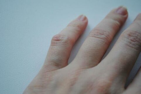Arthritis lumps appear on the little finger.
