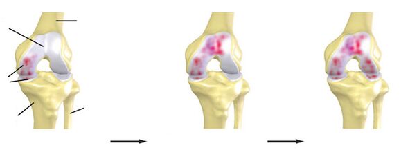 The level of arthrosis of the knee joint