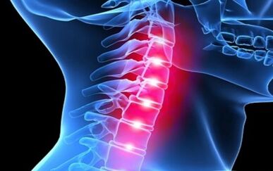 Symptoms of cervical spinal osteochondrosis