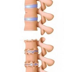 Neck osteochondrosis stage