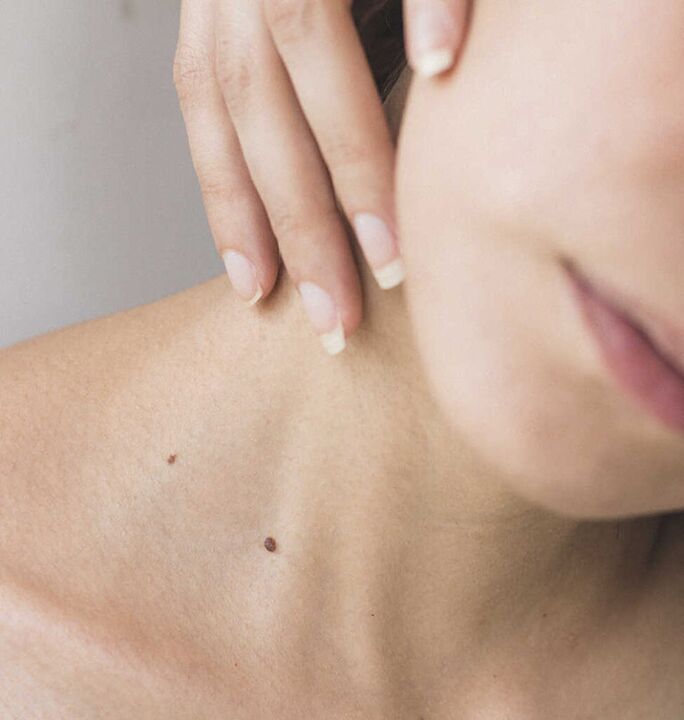 Stiffness in the neck is one of the early symptoms of cervical spine osteochondrosis